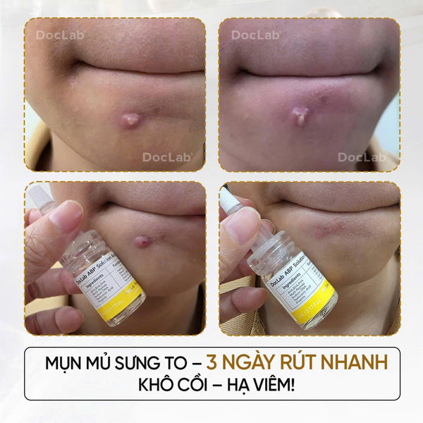DocLab - ABP Solution Ampoule V2: TBG đặc trị mụn - 5ea