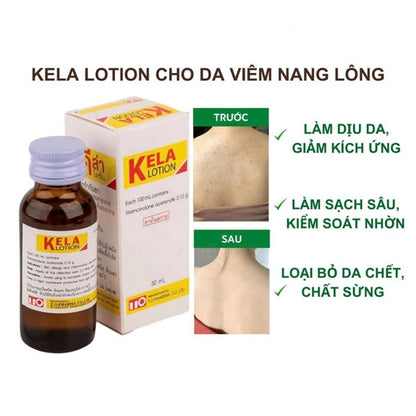 THÁI LAN - Kela Lotion trị viêm lỗ chân lông LCL - 30ml - EXP 2028.12