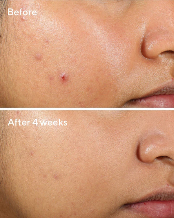 ACNE - Kem Dưỡng Ẩm Dạng Gel Mỏng Nhẹ Cho Da Dầu Mụn Murad Clarifying Water Gel