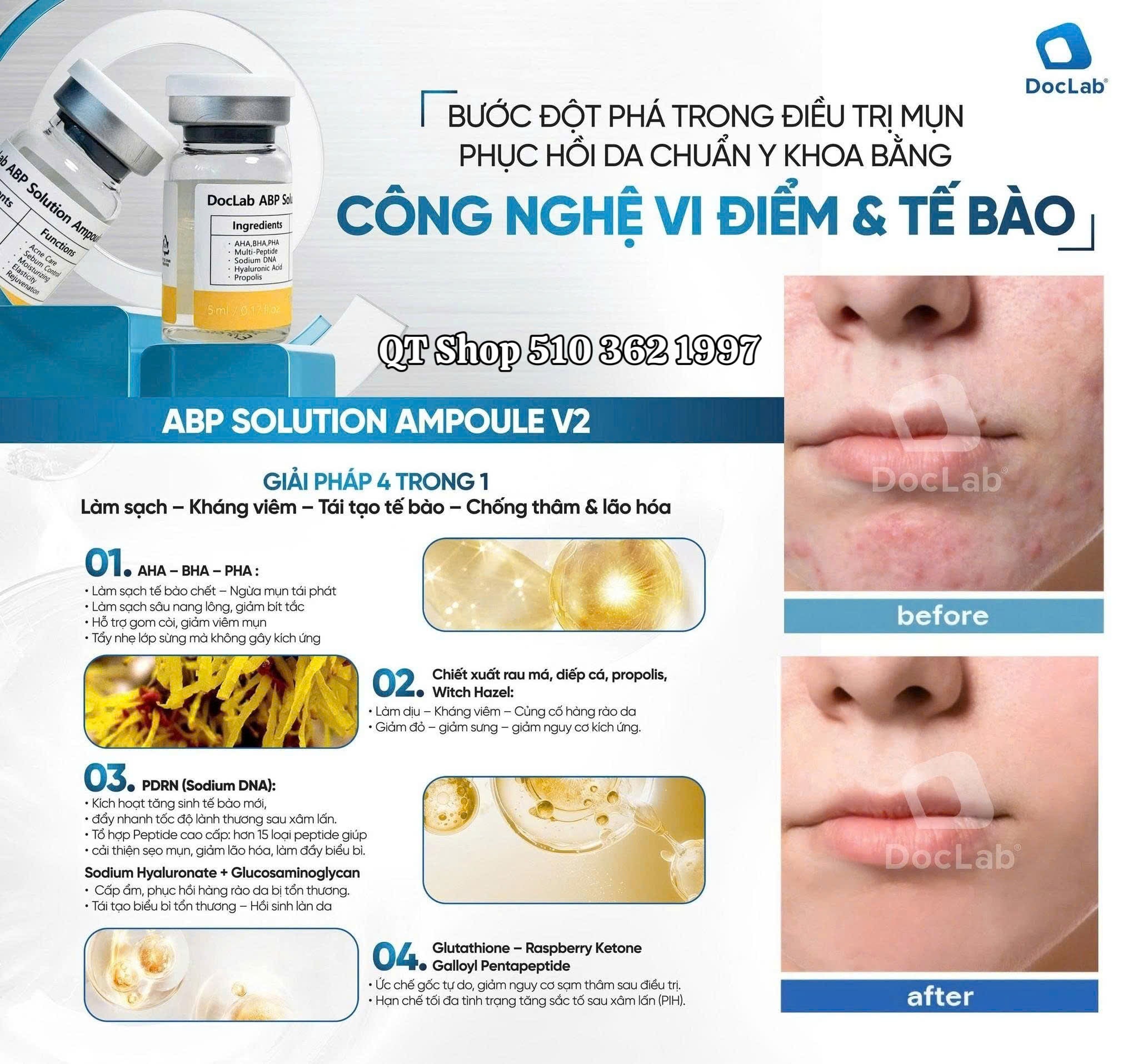 DocLab - ABP Solution Ampoule V2: TBG đặc trị mụn - 5ea